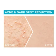 Garnier Fast Clear 4% Salicylic Acid, Vitamin C, Niacinamide, AHA – Anti-Acne Treatment Booster Serum