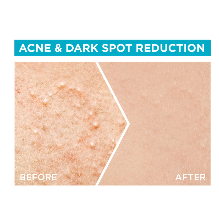 Garnier Fast Clear 4% Salicylic Acid, Vitamin C, Niacinamide, AHA – Anti-Acne Treatment Booster Serum