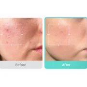 MEDICUBE Azelaic Acid 16BB Calming Serum Mask